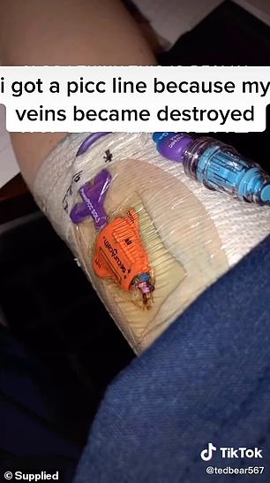 The thick catheter needle remained in Remi's arm for three months and she had to avoid getting it wet